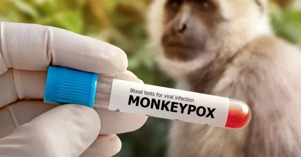 Aumentan los casos de viruela del mono en el país